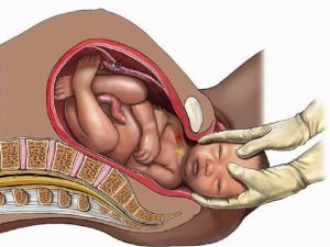 زایمان طبیعی بدون درد