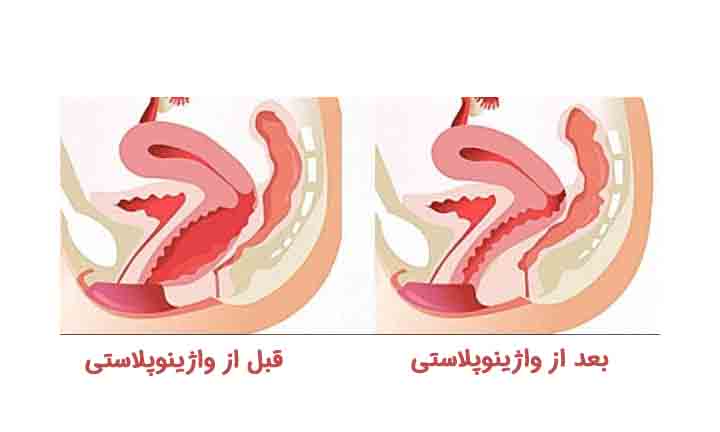 عمل تنگ کردن واژن