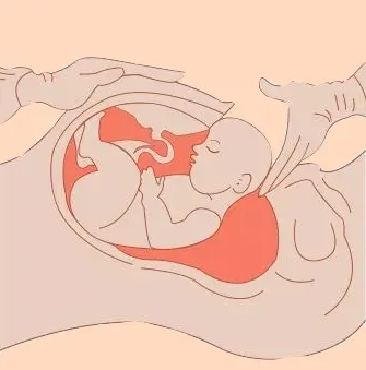 جراحی سزارین