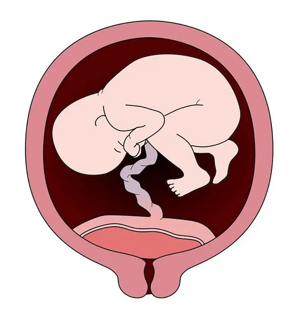 سزارین جفت سر راهی