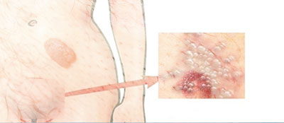 درمان زگیل تناسلی