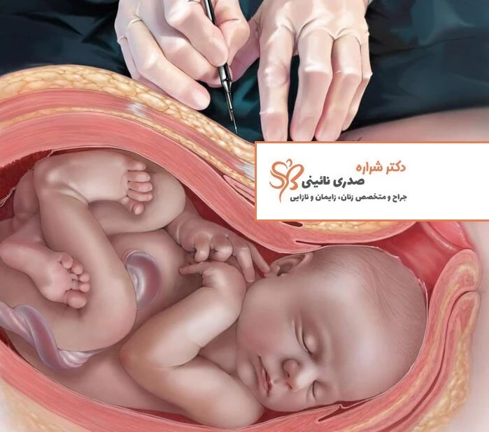 سزارین برنامه ریزی شده