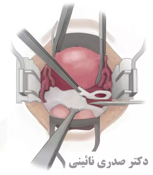 جراحی هیسترکتومی