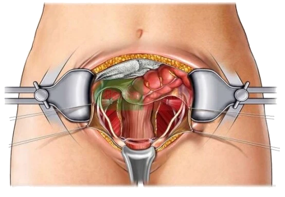 دلایل هیسترکتومی