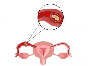 بارداری خارج از رحم