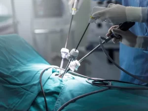 لاپاراسکوپی فیبروم رحم