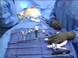 تفاوت لاپاراسکوپی و لاپاراتومی