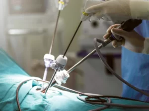 خونریزی بعد از لاپاراسکوپی