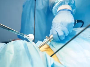 لاپاراسکوپی در بارداری