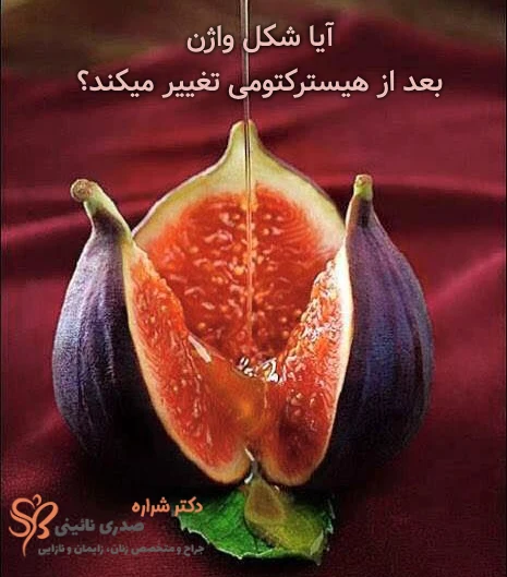 تغییر شکل واژن بعد از هیسترکتومی