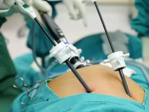 هیسترکتومی لاپاراسکوپیک