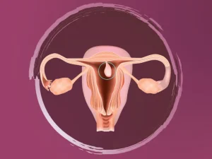 پولیپ رحم چیست