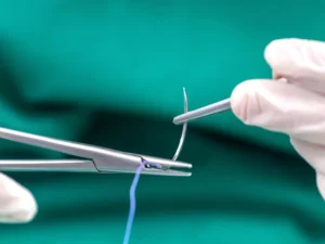 جای بخیه لاپاراسکوپی